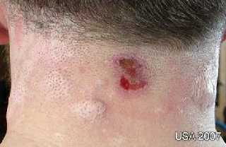Halswunden durch Morgellons, Bildquelle: http://www.morgellons-research.org/morgellons2/